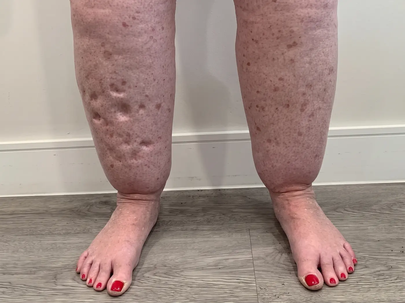 Legs with the disproportionate, swollen pattern typical of lipedema, standing on a wooden floor